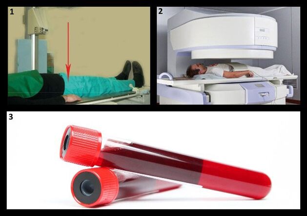 კოქსართროზის დიაგნოზის მეთოდები - ჰიპ სახსრის რენტგენი და MRI, სისხლის ტესტი