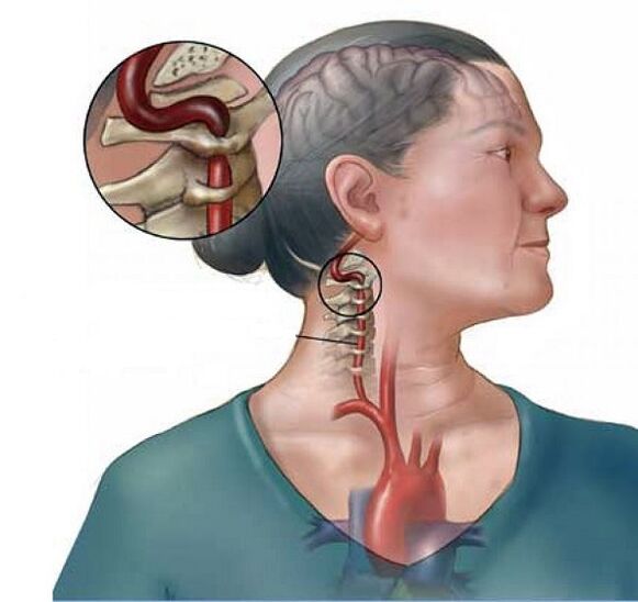 ხერხემლის არტერიის სინდრომი საშვილოსნოს ყელის ოსტეოქონდროზით